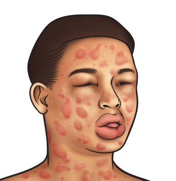 Prevent Allergic Reaction